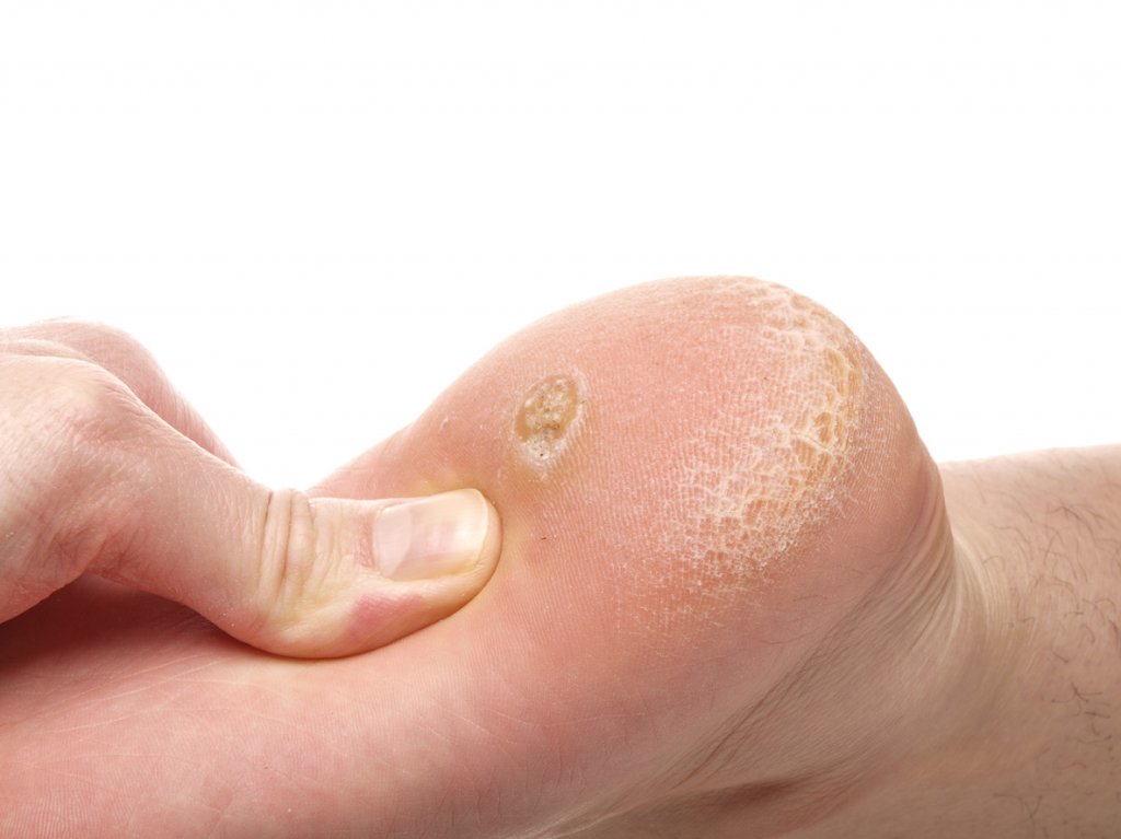 Warts - Sole Health Podiatry